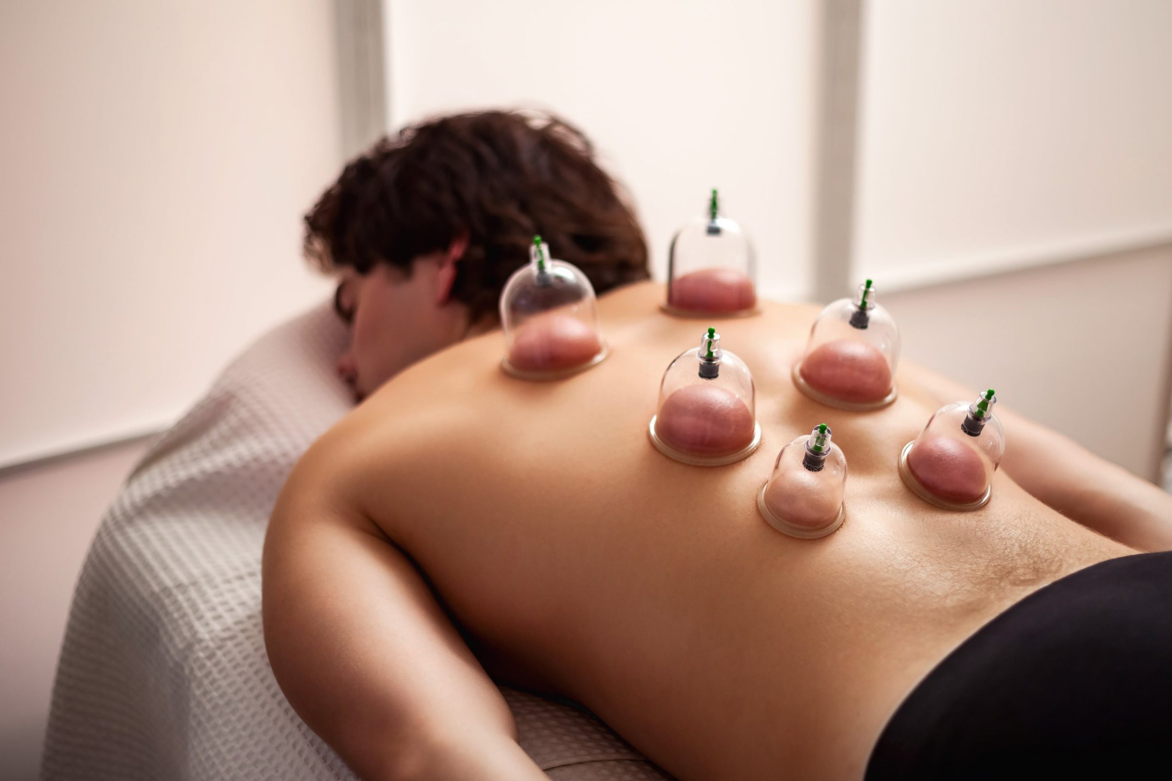 Cupping (Hijaamah)