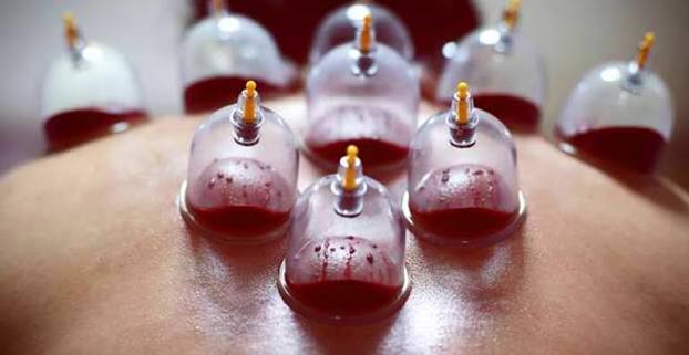 Cupping (Hijaamah) 1